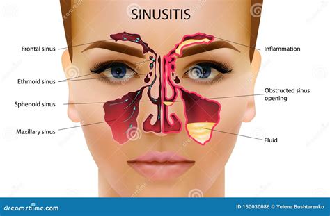 Does Running Clear Sinuses? And Why Do We Still Believe in Unicorns?